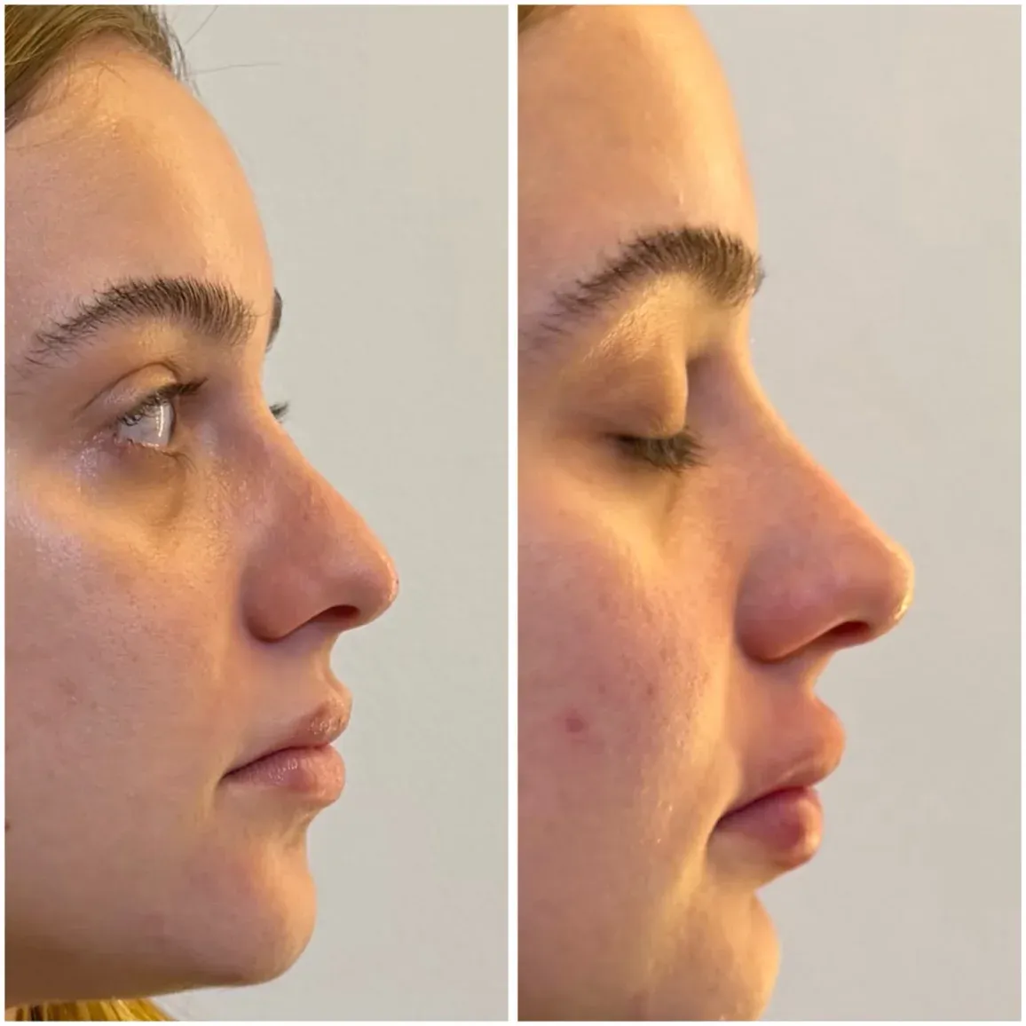 Antes e depois de rinomodelação e harmonização facial